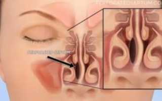 Синехии в носу после операции