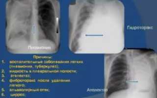 Гидроторакс при пневмонии