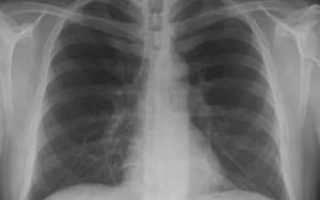 Пневмония фото рентген до и после