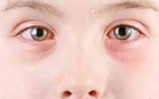 Чешутся глаза у ребенка причины