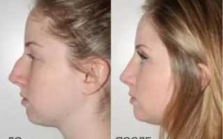 Как убрать горб на носу