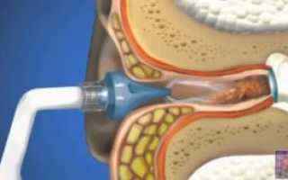 Как почистить уши ребенку от серных пробок