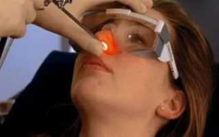 Лечение носа лазером