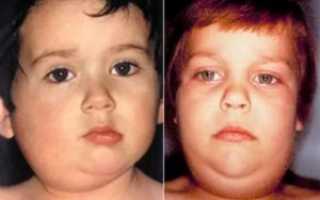 Неинфекционный паротит у взрослых