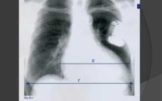 Диафрагмальные спайки в легких