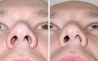 Почему заложена одна ноздря