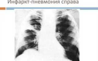 Инфарктная пневмония