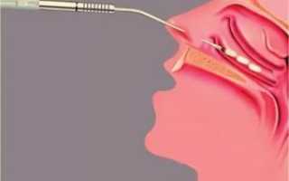 Радиоволновая коагуляция нижних носовых раковин