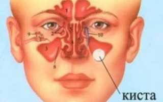 Киста в правой гайморовой пазухе