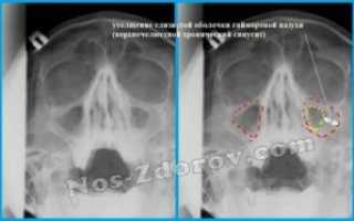 Отек слизистой оболочки верхнечелюстных пазух