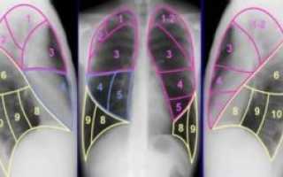 Сегменты легкого на рентгенограмме