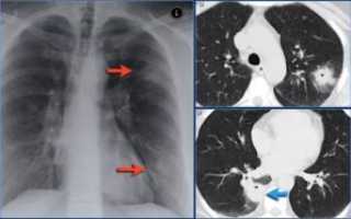 Периваскулярные изменения в легких
