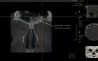 Остеома лобной пазухи лечение