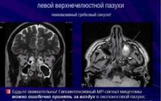 Мицетома верхнечелюстной пазухи