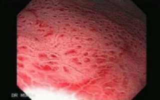 Гиперемирована что это значит