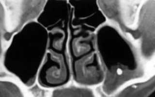 Инородное тело в гайморовой пазухе операция
