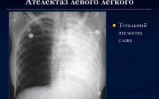 Ателектаз легкого рентгенограмма