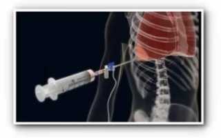 Пункция легких как делают