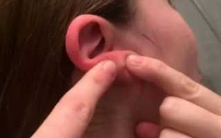 Опухла мочка уха шишка чем лечить