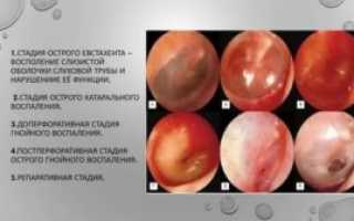 Серозный отит у детей лечение