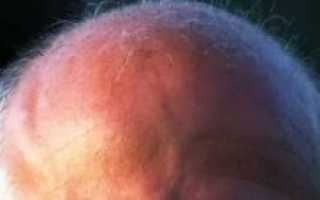 Мурашки на затылке причины