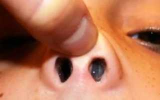 Отек носа у новорожденного что делать