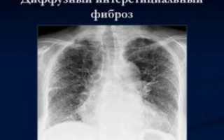 Посттуберкулезный пневмофиброз