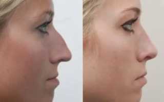 Можно ли изменить форму носа без операции