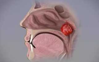Болезни носоглотки у детей