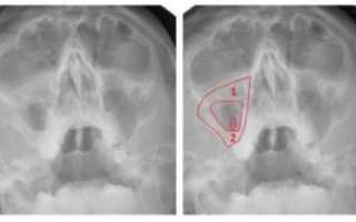 Пристеночный отек слизистой верхнечелюстной пазухи