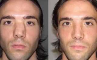 Как выпрямить нос без операции