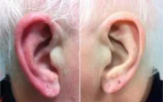 Перелом хряща уха