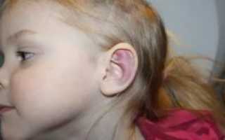 Ушиб уха как лечить