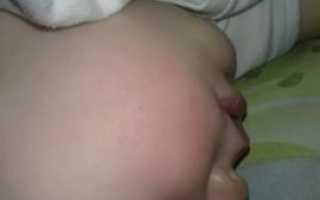 Красные щеки у ребенка 1 год