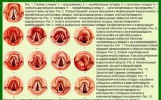 Можно ли гулять при ларинготрахеите