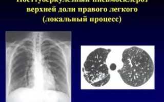 Посттуберкулезные изменения легких что это