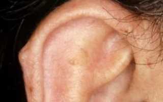 Нарост на ухе у человека фото