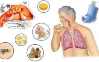 Аллергический синусит симптомы и лечение у взрослых