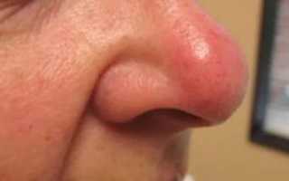 Опухает нос причины