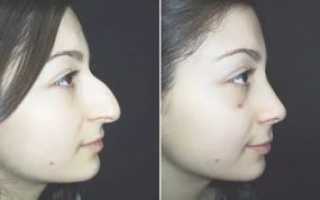 Как убрать горбинку на носу без операции