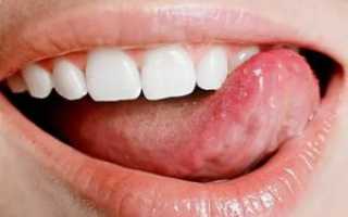 Воспаление слизистой во рту причины
