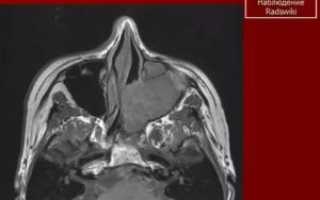 Рак носовых пазух фото