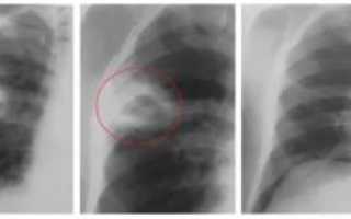 Абсцесс легкого рентгенограмма