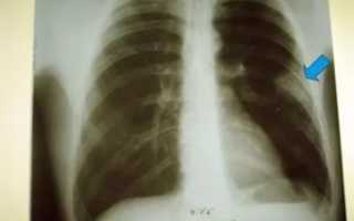 Плевропульмональные спайки в лёгких