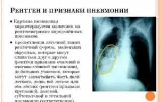 Рентгенологические признаки пневмонии