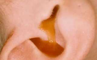 Жидкость в ушах у ребенка лечение