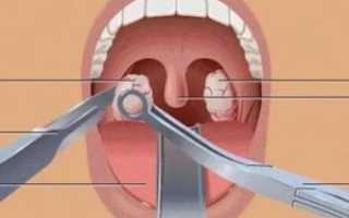 Как удаляют гланды у детей