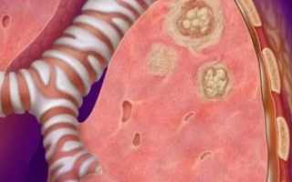 Туберкулёма лёгких заразна или нет