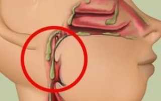 Субатрофический ринофарингит симптомы лечение