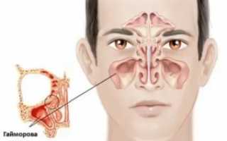 Дышит ли нос при гайморите